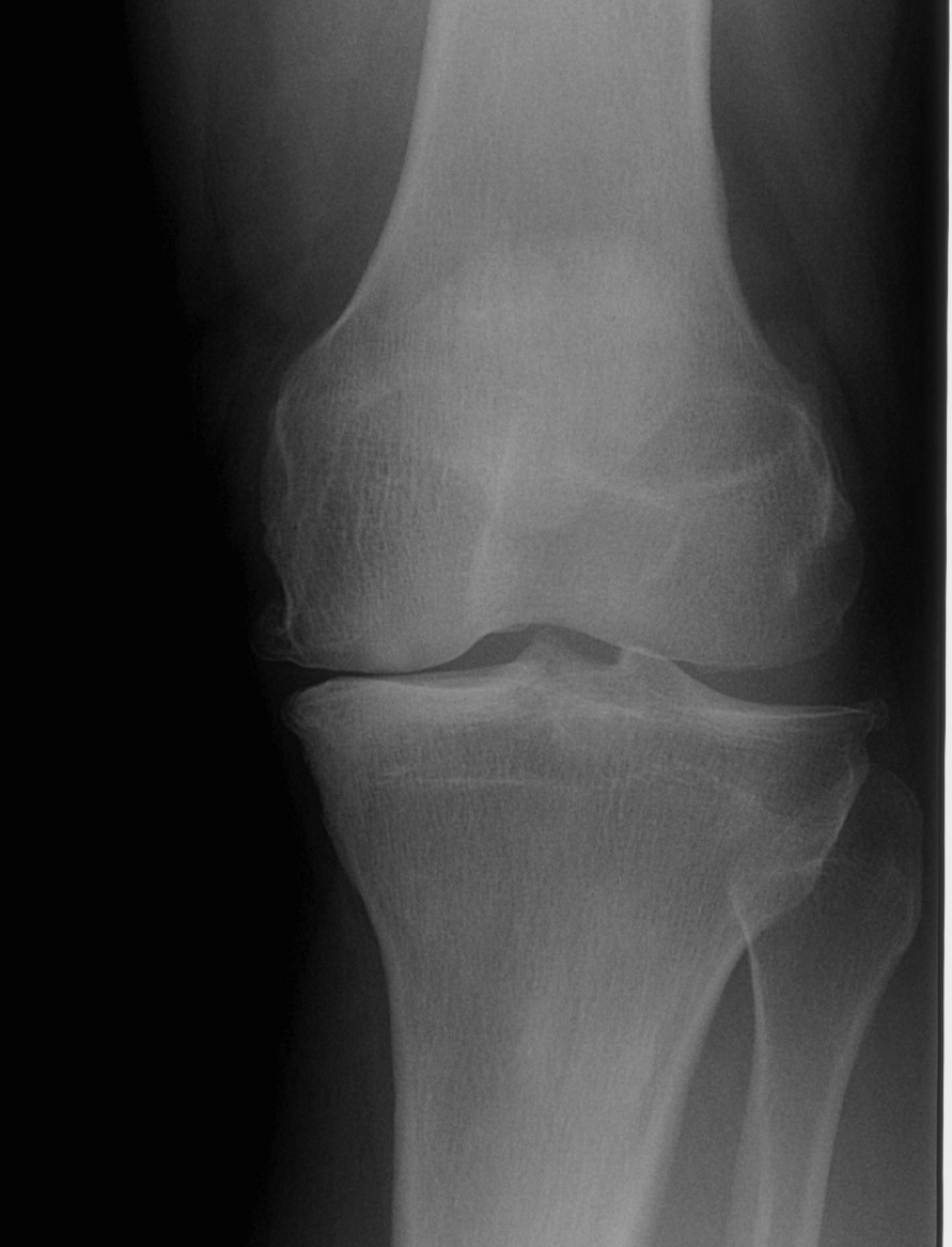Knee Medial Compartment OA